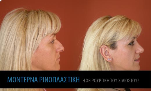 ρινοπλαστική