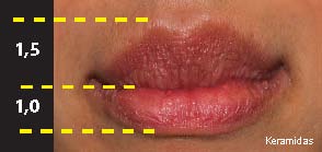 Παραμορφωμένα είναι τα χείλη όπου το άνω χείλος είναι μεγαλύτερο σε σχέση με το κάτω.